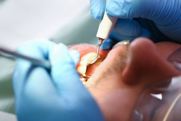 Best Emergency Dental Extractions in Marcellus, MI