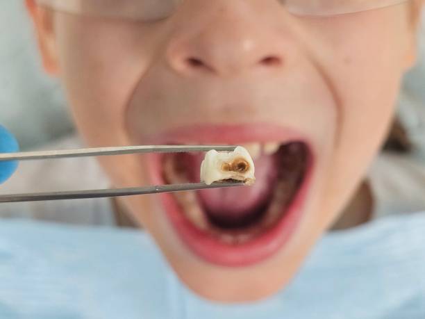 Best Emergency Dentist for Lost Fillings or Crowns in Marcellus, MI